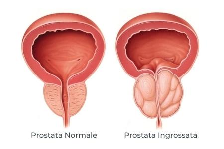 Prostata Ingrossata E Infiammata Cause Sintomi E Rimedi